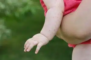 Top Natural Allergy Medicine for Kids