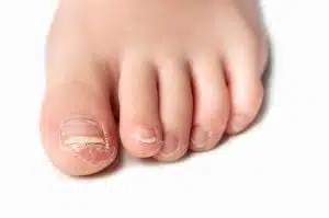 Fungal Infection in Kids