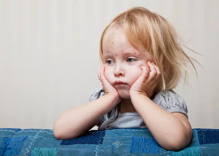 Common Skin Problems in Children