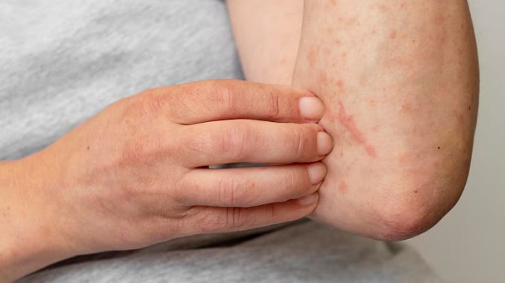 Child’s Skin from Irritants