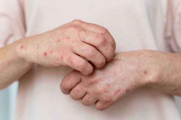 Eczema in Children