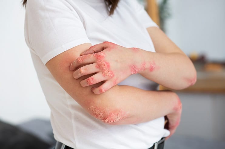 Hand, Foot & Mouth Disease
